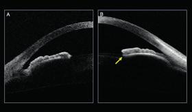 É importante ter atenção quanto à posição da inserção da íris, que pode estar localizada mais próxima à cabeça do corpo ciliar (A) ou mais próxima à parede escleral (B).