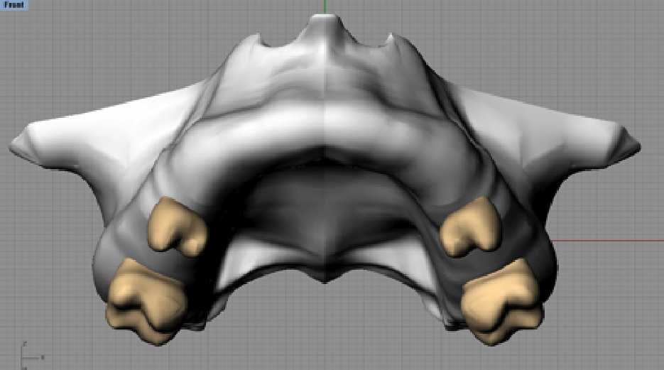 zigomáticomaxilar e disjunção da sutura intermaxilar (Figura 4); Modelo 3 (M3): Simulação de osteotomia Le Fort I com