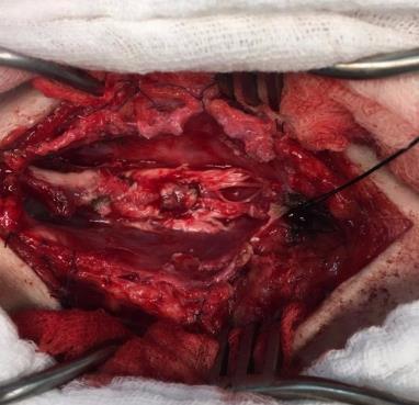 FIGURA 01: Lesão expansiva perolácea no compartimento dural. Fonte: Imagens cedidas pelo serviço de neurocirurgia do Hospital da cidade da Zona da Mata Mineira.
