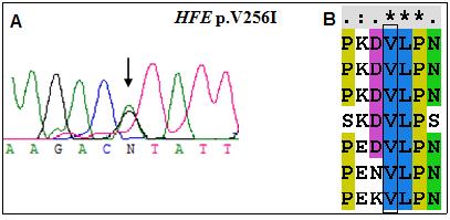 Figura 13. A: Resultado do sequenciamento demonstrando a heterozigose para a mutação p.v256i encontrada no gene HFE.