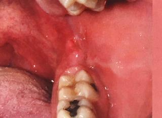Pericoronário: bactérias colonizam o opérculo gengival que recobre um dente semi-incluso, gerando infecções. A Figura 1 representa tais situações clínicas.