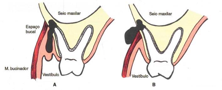 com as inserções musculares na maxila e mandíbula (HUPP, EDWARD e MYRON; 2015). As Figuras 2 e 3 mostram os fatores que determinam a progressão da infecção.