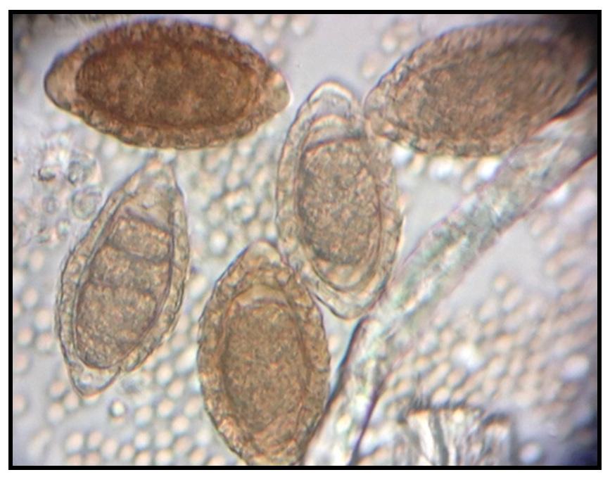 99 Figura 1. Sedimento urinário por microscopia de luz, observa-se ovos elípticos, castanhos e com casca espessa (Laboratório Clínico- Hospital Veterinário Dr. HalimAtique UNIRP, 2016). Tabela 1.