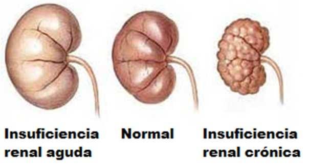 Insuficiência renal - Diminuição ou parada total da atividade dos rins e, consequentemente, da produção de urina, levando ao acúmulo de substâncias prejudiciais ao corpo no sangue; - Se não for