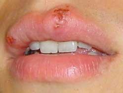 Herpes Bucal -