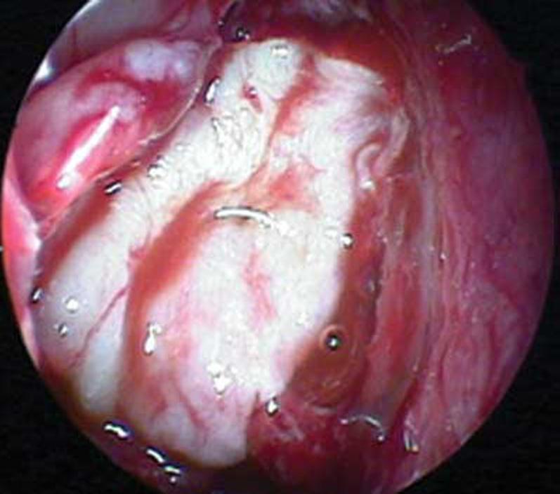 defect, on back of the posterior wall of the frontal sinus, by intracranial route 2. In 1964, Vrabec and Hallberg described endonasal approach to repair a SF leak in the cribriform lamina 2,3.