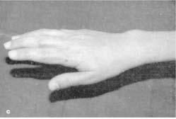 A hipercorreção foi notada em três dedos (4,5%), ocasionando a deformidade em botoeira. A função foi considerada melhor por 84% dos pacientes.