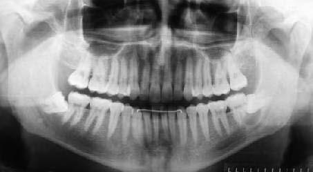A idade média de acometimento desses cistos para os primeiros, segundos e terceiros molares inferiores é de 8.7, 17.4 e 27.6 anos, respectivamente (2).