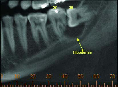 Figura 8 - Aspecto da lesão associado ao dente após sua remoção (2007) Figura 5 - Tomografia cone bem evidenciando a