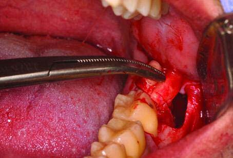 A incisão realizada para terceiros molares permitiu o acesso e descolamento do retalho, possibilitando a visualização de