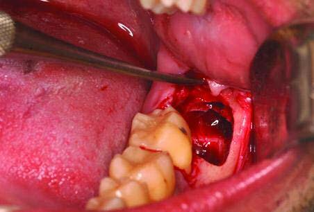 solução salina. A remoção do dente possibilitou a exérese da lesão que continha o capuz pericoronário (Figuras 7 e 8).