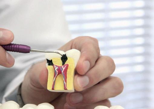 Tratamento de Canal A Endodontia é a especialidade da Odontologia que trata as lesões e doenças relacionadas à polpa (nervo) e à raiz do dente.