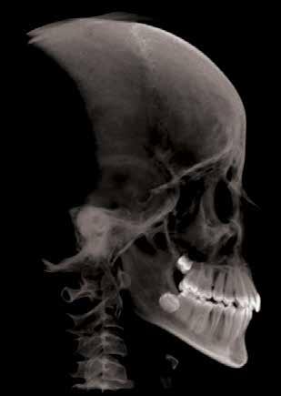 68 Figura 4 (-) Vista frontal e lateral do crânio na tomografia inicial. pós o planejamento do caso, optou-se por utilizar a técnica de colagem indireta.