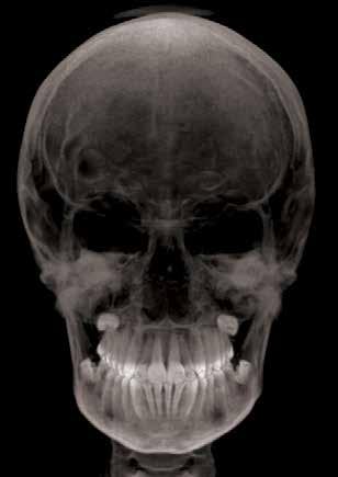 022 (merican Orthodontics, Sheboygan, WI, EU). Inicialmente, foi realizado o escaneamento intrabucal no consultório odontológico com o scanner itero (lign Technology, Inc.