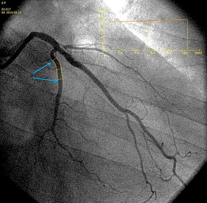 29 Figura 5 - Local de interesse para análise angiográfica da prova de vasomotricidade. As setas apontam para os 5mm proximais e distais ao stent no segmento.