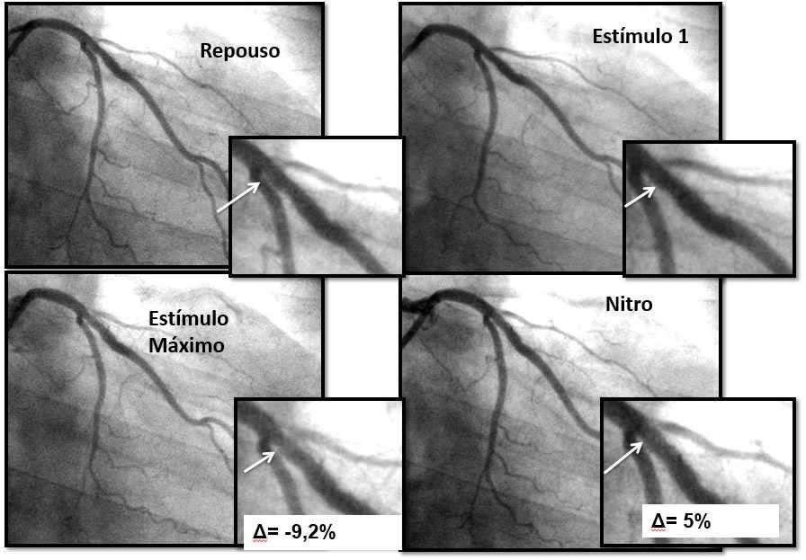 48 5.5.2 Resposta vasomotora coronariana A análise da vasomotricidade consistiu na medida por angiografia quantitativa seriada do diâmetro médio das bordas proximal e distal e do segmento controle no