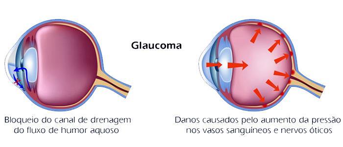 Glaucoma O glaucoma é uma doença ocular caracterizada por alteração do nervo óptico que leva a um dano irreversível das fibras nervosas e, consequentemente, perda de campo visual.