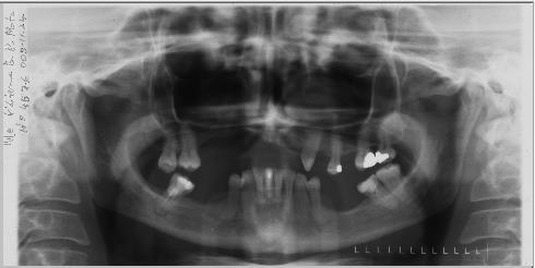 Figura 2 - Ortopantomografia pós-operatória (aproximadamente um ano depois) da paciente do caso nº3.