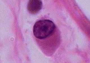 Linfócitos e Plasmócitos Plasmócito - é uma célula ovalada que