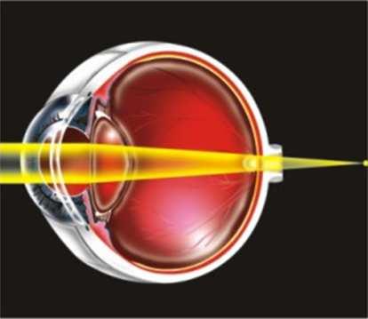 10 1.2.1 Miopia Na miopia, a convergência refracional do olho (com acomodação em repouso) é excessiva com relação ao comprimento axial do olho.