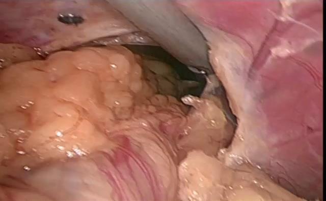 o diafragma. Não foi visualizado na cavidade abdominal o cólon transverso, o estomago e parte do jejuno, caracterizando a hérnia diafragmática (Figura 3). Iniciamos a liberação das aderências, no Fig.