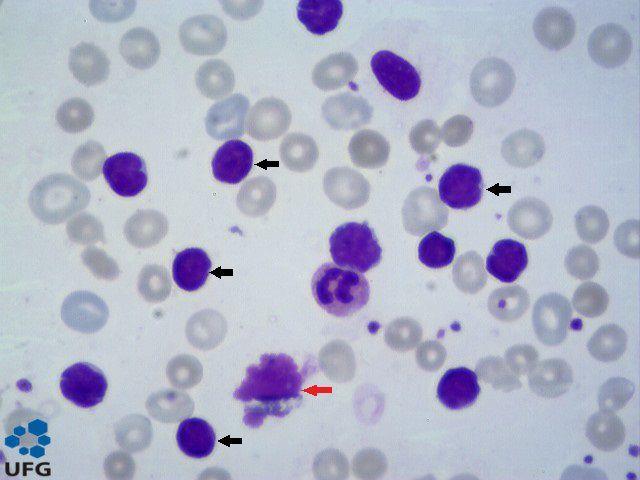 27 1.1.4. Achados hematológicos O achado hematológico mais frequente é linfocitose persistente.