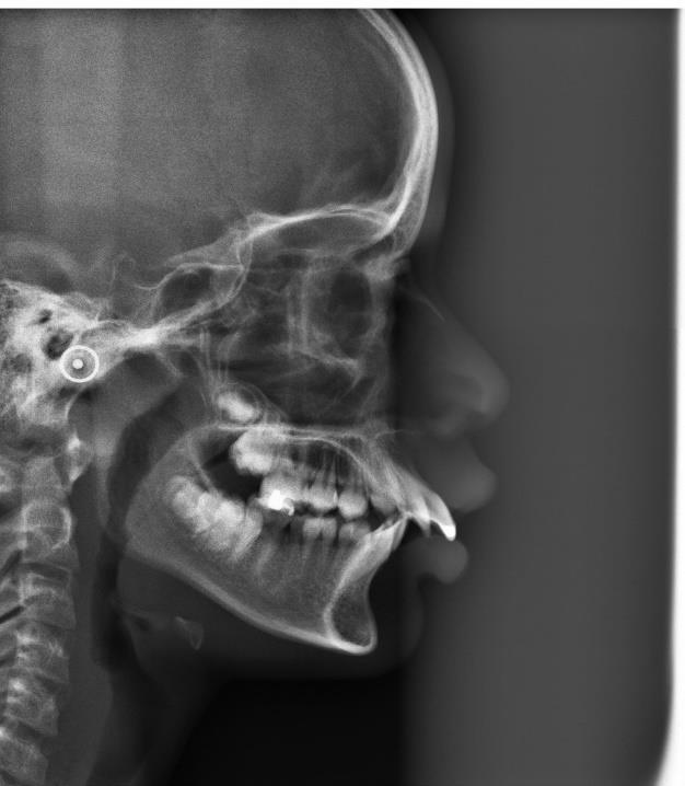 12 Na telerradiografia observa-se um grande vestibularização e protrusão dos incisivos superiores e os incisivos inferiores e perfil convexo (Figura 4).