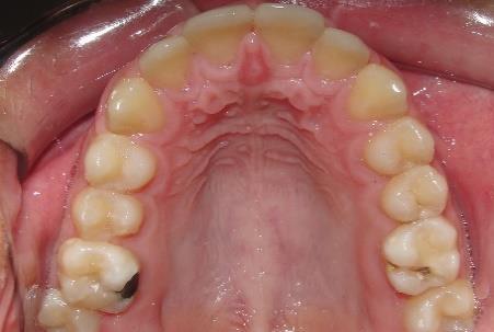 intrabucal oclusal superior final; H) Fotografia