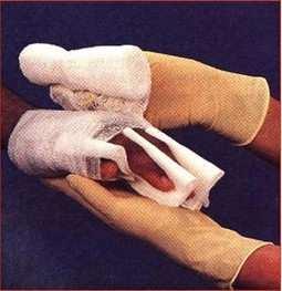 Tratamento Indicado : Separar os dedos com