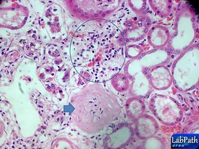 citoplasmáticos e nuclear - reação inflamatória Imagens de parênquima renal em necrose