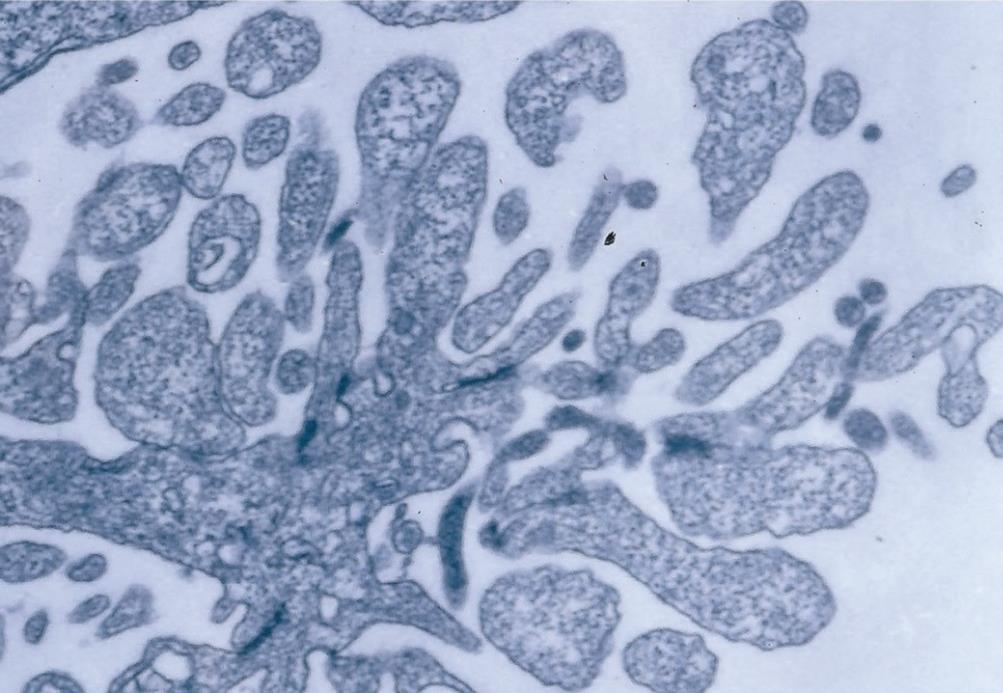 Morte celular Apoptose Necrose Fragmentação do citoplasma em bolhas, que conservam a