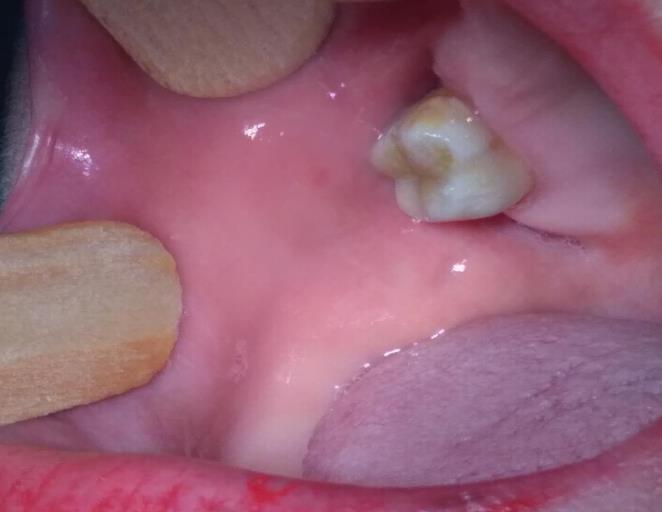 Ao retorno foi possível verificar a higienização insatisfatória de toda a região oral, presença de biofilme dental, lesões de cárie, fratura das restaurações, dentre outros problemas dentais