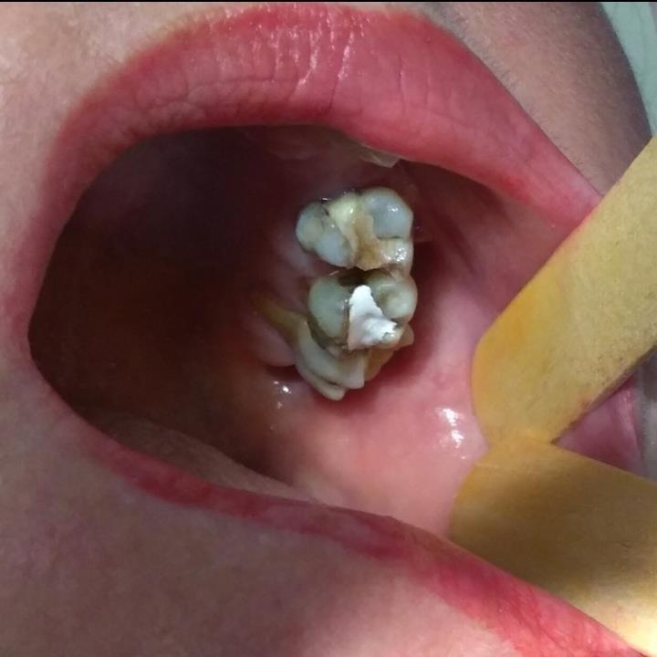 Imagem 4 - Imagem de 2 anos após o tratamento. Observa-se na imagem o descuido com a higiene oral ocasionando a formação de biofilme dental, cárie e fraturas das restaurações.