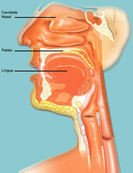 Anatomia na T21 Terço médio da face é proporcionalmente menor Achatamento da face (ânteroposterior) = braquicefalia