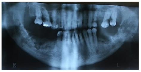A osteomielite pode ter origem hematogênica, dentária ou traumática.