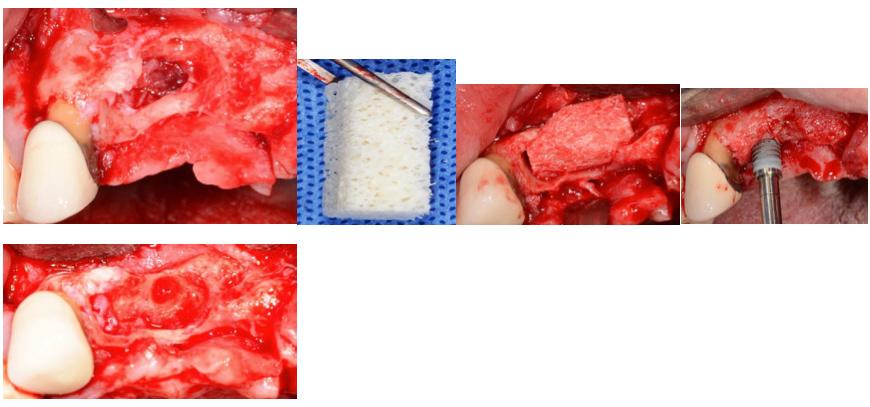 8 OSSO HOMÓLOGO EM BLOCO LIOFILIZADO IRRADIADO APLICAÇÕES MAIS FREQUENTES: Por se tratar de um osso com rápida vascularização, é indicado para enxertos onlay, confecção de Bone Ring, entre outras