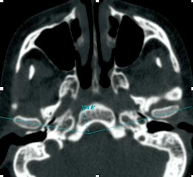 21 154,6 Figura 3 - Vista axial de uma tomografia computadorizada das ATM ilustrando o ângulo formado nas linha traçadas pelas cabeças da mandíbula direita e esquerda. Fonte: Alomar et al. (2007).