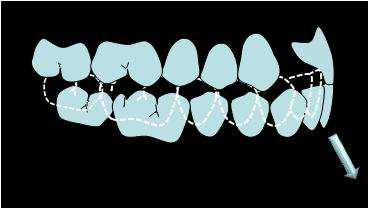 33 Figura 5 - Esquema ilustrando a guia anterior, em que as vertentes-guia são responsáveis pelas características do movimento com desoclusão dos dentes posteriores.
