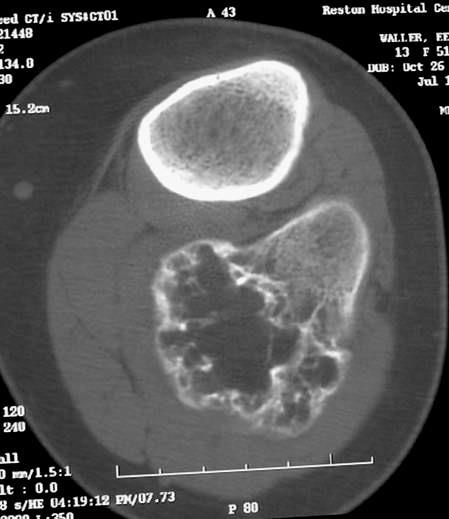 Osteocondroma