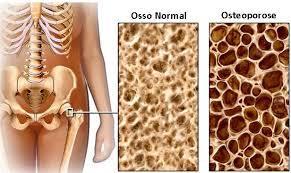 Osteoporose generalizada Congênita Senil Endócrina Neurovascular Deficiência