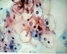 Acúmulo proteínas (antígenos) virais Sincícios