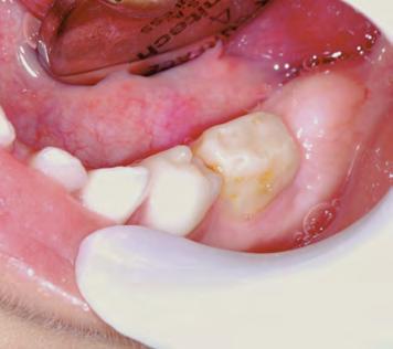 GRAU DE INFRAOCLUSÃO Estágio leve: quando a superfície oclusal está localizada, aproximadamente, a 1 mm abaixo do plano oclusal dos dentes adjacentes (Figura 09).