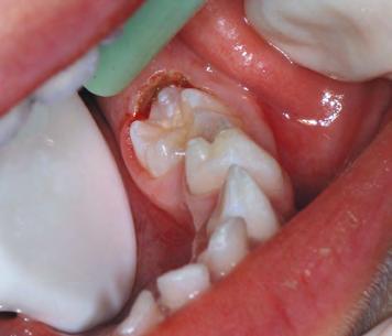 Estágio Severo: quando a superfície oclusal está localizada no nível ou abaixo do tecido gengival interproximal de um ou ambos os dentes adjacente (Figura 10).
