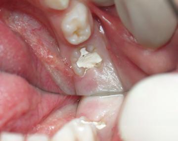 reabsorção, podendo afetar a erupção do dente permanente.
