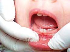 Já erupção dentária é conceituada como o processo que se inicia na odontogênese, passa pela fase de irrupção na cavidade bucal e chega à posição final de oclusão, aonde exerce sua função.