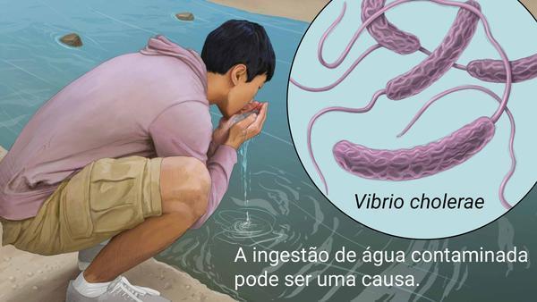 Cólera Causador: vibrião Vibrio cholerae; Sintomas: diarreia característica (fezes esbranquiçadas e muito líquidas) que pode causar desidratação, além fortes dores