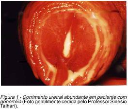 Gonorreia Causador: Neisseria gonorrhoeae; Sintomas: dor, ardência e produção de pus ao urinar, tanto em