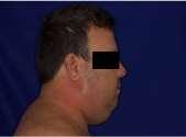 transcorrido a cirurgia com ventilação assistida. Figura 4: Inspeção Facial: A) Largura e comprimento do pescoço; B) Retrognatia; C) Abertura limitada de boca.
