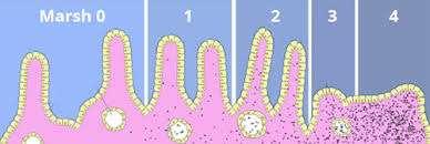 Além da forma clássica, é importante lembrar que se considera a Dermatite herpertiforme como manifestação cutânea da enteropatia celíaca, a qual consiste em presença de lesões bolhosas e intensamente