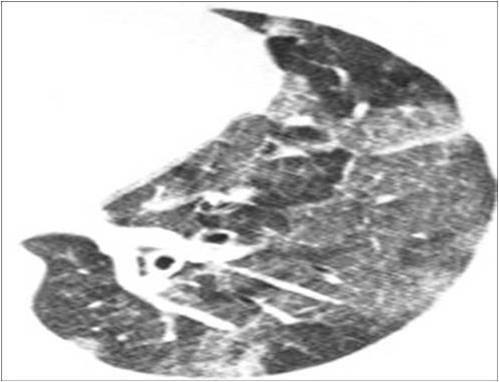 Vidro-fosco Na TC, corresponde ao aumento da densidade do parênquima pulmonar em que permanecem visíveis os contornos dos vasos e brônquios no interior da área acometida por um processo patológico.